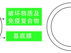 關于對(duì)尿蛋白、尿潛血控制的(de)錯誤與激素、細胞毒類藥物(wù)治療腎病的(de)誤區(qū)