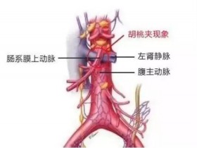 胡桃夾現象是腎炎嗎？兩者如何區(qū)别？